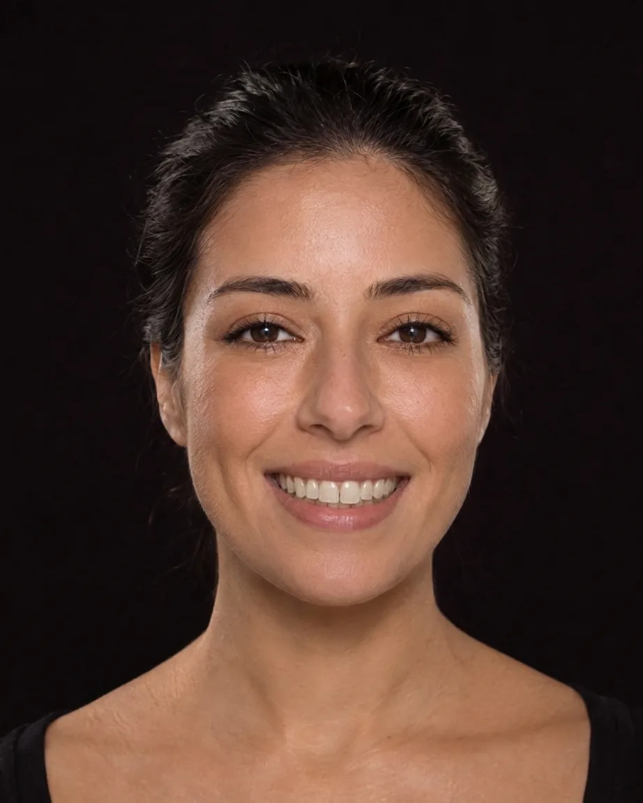 Mesmos dentes com preparo mínimo da superfície